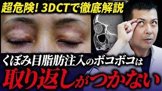 くぼみ目への脂肪注入の危険性について、CTスキャンを使って徹底解説。くぼみ目は個性！！