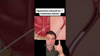Вот какие камни бывают в слюнных железах