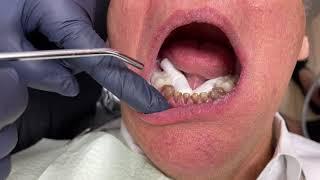 Houston Cosmetic Dentist...How to disguise dark front teeth with veneers...Step by Step