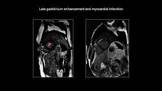 Cardiac Magnetic Resonance Imaging CMR in Myocardial Infarction