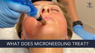 Here’s Why You Should Try Microneedling