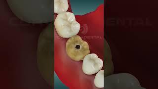 Tooth extraction in 3D animation | Curveia Dental #toothextraction