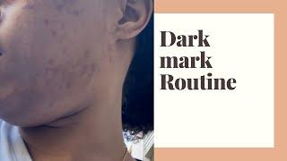 Safely Fade Dark Marks, Hyperpigmentation  & Skin Discoloration II Acne Journey