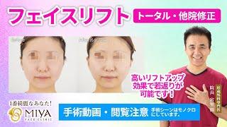 【顔のたるみ取りと若返り！】フェイスリフト(トータル・他院修正)の施術と症例 ／MIYAフェイスクリニック