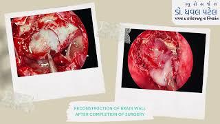 Endoscopic Brain Surgery of Pituitary Tumor by best brain & spine surgeon in Surat, South Gujarat