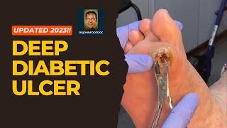 How to Cure Deep Diabetic Ulcers Fast