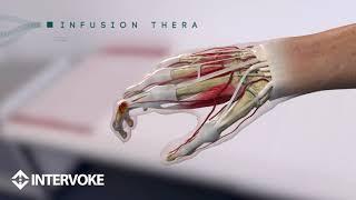 Infusion Therapy Rheumatoid Arthritis Demo