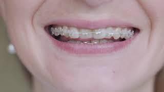 Benefits Of Ceramic Braces | Bellaviso Medical Center Dubai