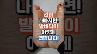 간이 나빠지면 발바닥이 이렇게 변합니다!! #중년건강 #건강한중년 #건강정보 #지식 #장수의비밀 #건강관리 #건강상식 #건강 #50대건강