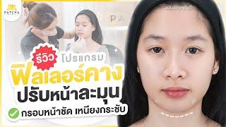 รีวิวฉีดฟิลเลอร์คาง ปรับใบหน้าให้ดูละมุน มีมิติได้สัดส่วน