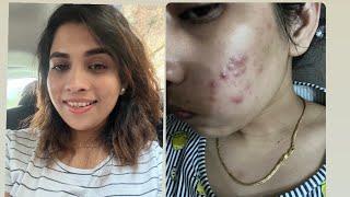 My acne journey.. 2022 to 2024 !! Clear skin transformation #acne #healing #skincare  #youtube