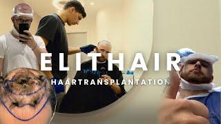 So läuft eine Haartransplantation ab bei Elithair.