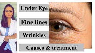 Fine lines | wrinkles| under eye|  causes & treatment| Prevention | Dr. Aanchal Panth