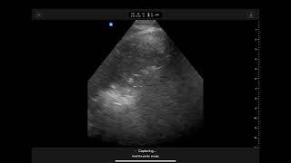 Overview of Butterfly IQ3 ultrasound probe