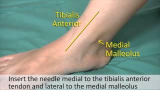 Musculoskeletal Examination and Joint Injection Series_ Ankle Joint Aspiration