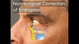 Non-Surgical Correction of Involutional Entropion