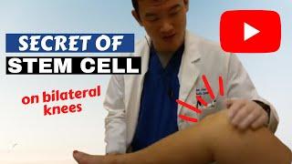 Secret of Stem cell  | Top Stem Cells for Bilateral Knee Pain Relief: Avoid Surgery
