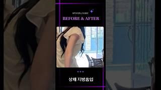 팔 지방흡입 후기 #지방흡입후기 #지방흡입