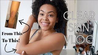 Healing & Living with Eczema | Zig Beswick