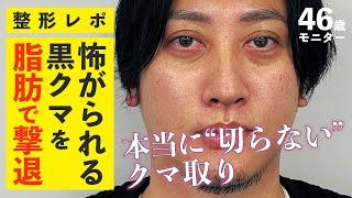 【 整形密着 】これが 本当の 切らない クマ取り ！ 脱脂 もしない クマ改善 の 新常識 【 メンズ整形 】