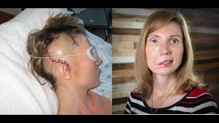 Brain Tumor Journey 2: From dizzy spells, headaches, vertigo, to diagnosis, Jodi Orgill Brown