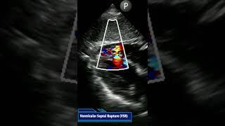 Someone had a cardiac arrest. What is going on?  #youtubeshorts #echocardiography #heart attack