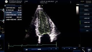 Ejection fraction measurement