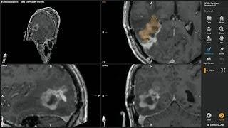 Smartbrush—Volumetric Tumor Outlining by Brainlab