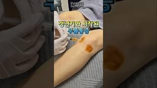 무릎통증과 갱년기 치료 진행 스토리 #무릎통증 #무릎퇴행성관절염 #무릎줄기세포치료 #갱년기