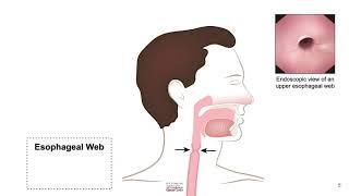 HCC 1475-2f3-Pathology of Esophagus-Esophageal Web