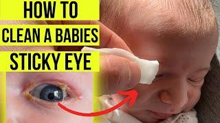 How to treat a STICKY EYE in babies (including eye-lid hygiene cleaning & tear duct massage)