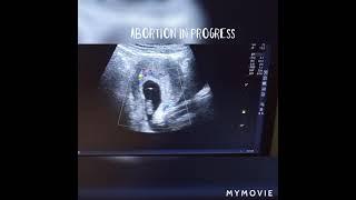 abortion in progress | ultrasound case