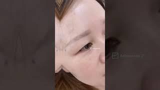 Transplantation hair and eyebrow #transplantationhair #transplantationeyebrow #brows #hair