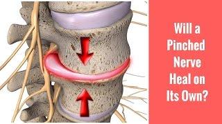 Will a Pinched Nerve Heal on Its Own? Discussed by St. Joseph, MI Chiropractor