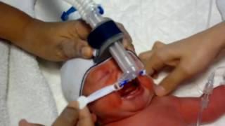 Attachment of bubble Nasal CPAP on a newborn