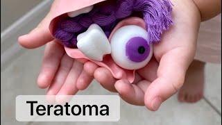 Playdough Surgery  ‍️ - Ovarian Cystectomy - Part II: Teratoma (Dermoid Cyst) Gross Exam