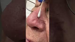 Let's Get That Thing Out! | Dr. Derm
