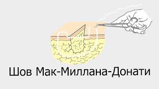 Шов Мак Миллана Донати