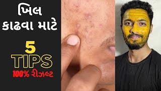 ખિલ કાઢવા માટે 5 ટીપ્સ ️ 100% Results  | ખીલની દવા | ખીલ મટાડવાના ઉપાયો