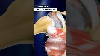 Surgeons Use Balloons to Fix Shoulder Pain Fast!