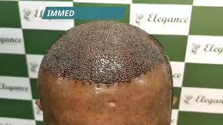 FUE Method of Hair Transplant| Hair Fall Treatment Adajan, Vesu, Kim, Surat, Navsari, Vapi, Gujarat