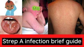 Strep A (Scarlet fever) infection information for patients.