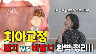 저 없이 발치하러 가지 마세요! 치아교정 발치 vs 비발치 완벽 정리!!