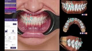 exocad no prep veneers in under 5 minutes using the patients natural teeth as the library