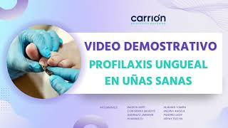 Video demostrativo de procedimiento de profilaxis ungueal en uñas sanas