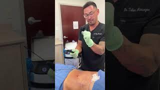 QuantumRF10 Live Treatment on Abdomen - Dr. Talon Maningas