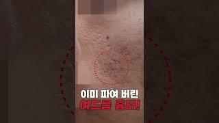 여드름 흉터 이렇게 되기전에 치료하세요! #shorts