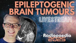 Epileptogenic brain tumours with Frank Gaillard