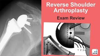 Reverse Total Shoulder Arthroplasty Exam Review - William N. Levine, MD