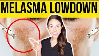 Get The Lowdown On Melasma From A Dermatologist